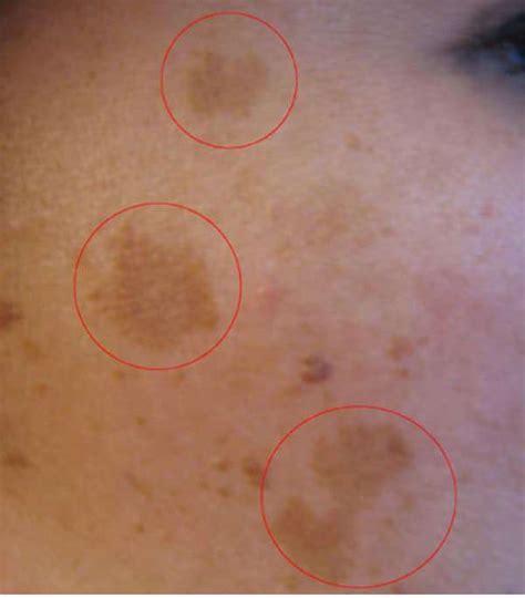 屁股長黑斑|黑斑 (Melasma)